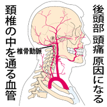 椎骨動脈の圧迫が血管性頭痛の原因 