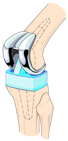 膝の人工関節イラスト