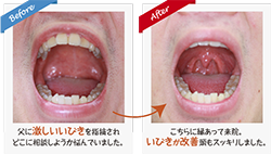 睡眠時無呼吸症候群(SAS)・のど咽頭事例