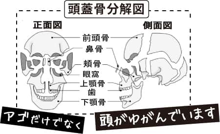 耳鳴り、めまいと頭蓋骨の歪み