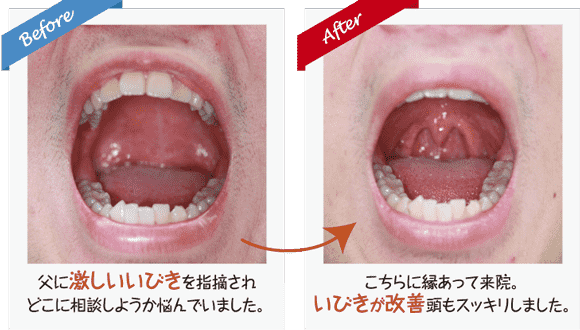 いびき、口の中、改善