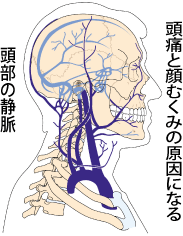 頚椎のズレは、頭痛と顔むくみ 原因になる