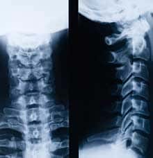 ミリタリーネック・頚椎X線