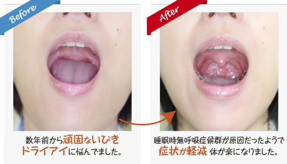 睡眠、質、いびき、口