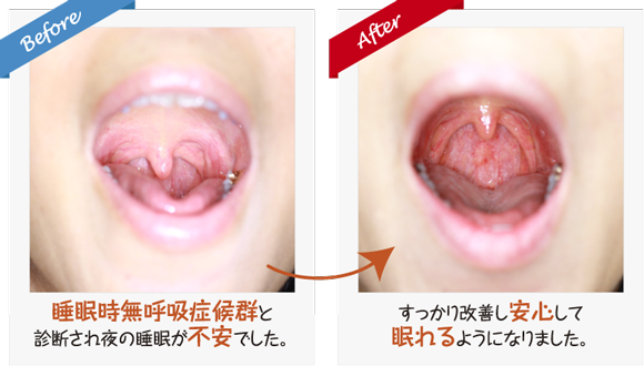 睡眠、質、いびき、口