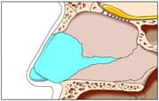 鼻の断面図で、花粉の原因となる、鼻の歪みを検証