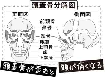 頭蓋骨ゆがみと頭痛