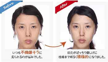 目の大きさ左右差