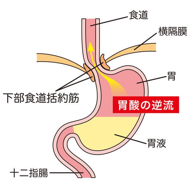 胃酸の逆流