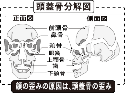顔の歪みと頭蓋骨の分解図.png